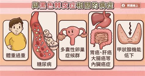 腋下長黑斑|照護線上｜腋下變黑，可能是罹病徵兆！單純發炎後色 